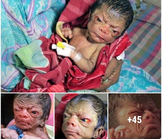 A baby girl resembling an “old lady” was born to an Indian woman.