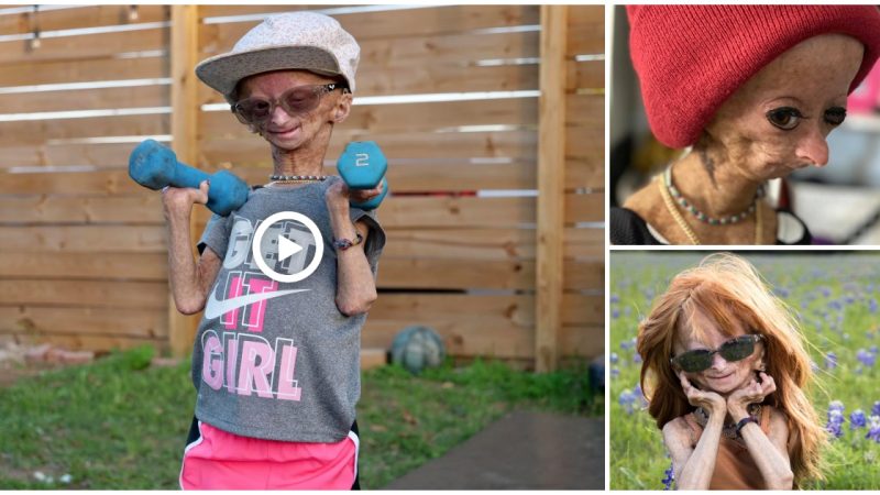 Adalia Rose Williams is a 15-year-old girl from Texas who has become an inspiration to millions of people around the world, with her age-old appearance and a very optimistic and loving life(video)