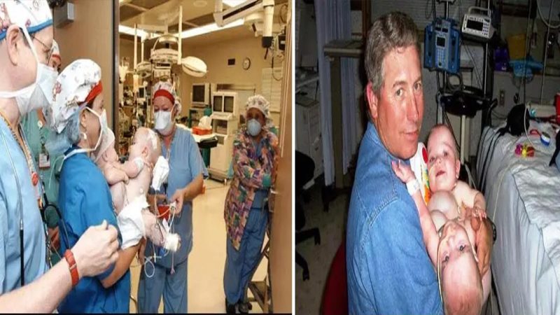 They share photographs of two of the surviving conjoined triplets taken fourteen years ago.