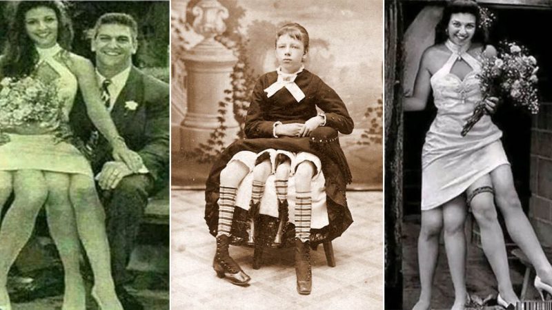 The Fascinating Story of Myrtle Corbin: The Four-Legged Lady from Sideshow History