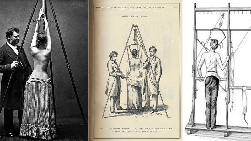 Dr. Lewis Sayre treating scoliosis, checking the curvature of the spine, 1870s