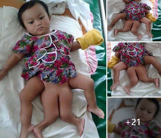 A Remarkable Tale of Compassion and Hope: Community Rallies to Help Baby Born with Four Legs in Thailand