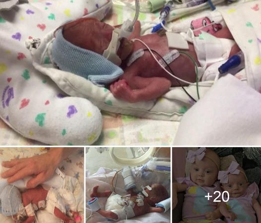 Baby Born Three Times Smaller Than Her Twin Sister Defies All Odds and Leaves Everyone Amazed.