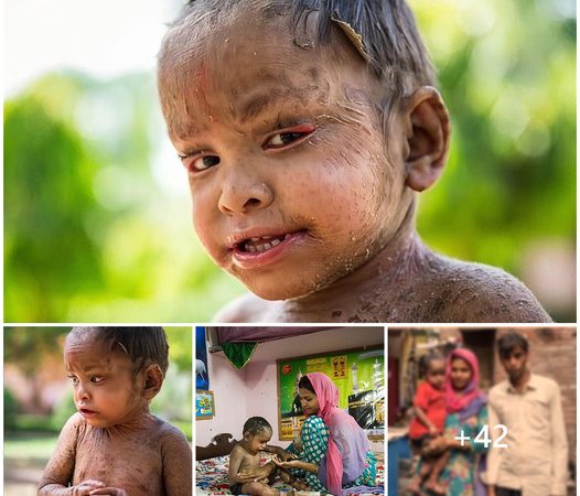 The Remarkable Story of a 2-Year-Old Girl with Skin Resembling Lizard Scales