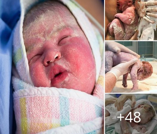 The Unexpected Marvel of Fetal Vernix Caseosa: Nature’s Gift to Newborns