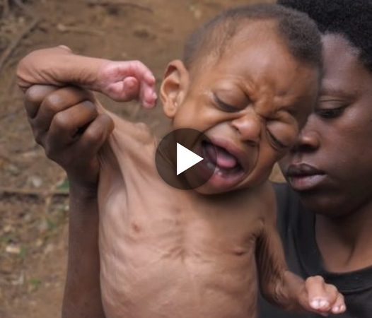 Astonishing Baby’s Rapid Aging Due to a Rare Medical Condition Shocks All