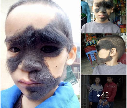 A Mother’s Hope: Transforming a “Monkey Face” Boy’s Life