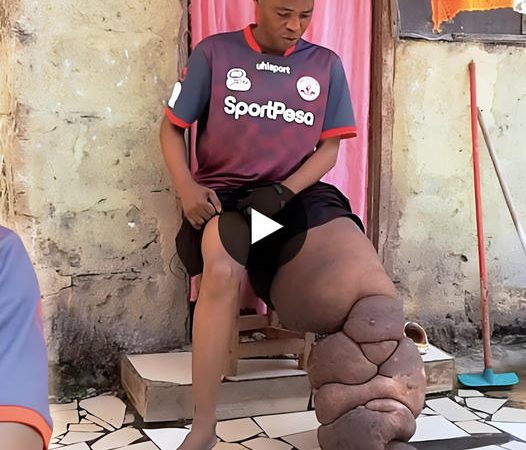 The Inspiring Journey of a Man Battling a Giant Leg Tumor for 25 Years