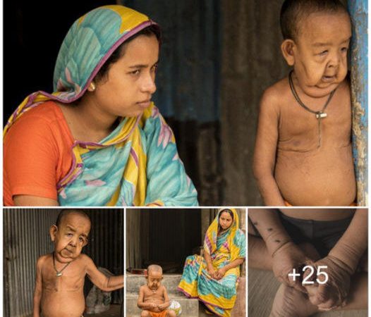 A Young Boy in India Afflicted by a Rare Disease That Ages Him Prematurely, Eliciting Sympathy from All