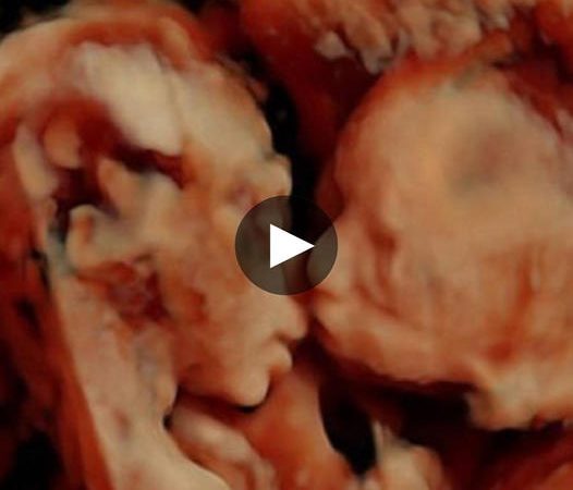 Sisterly Love Begins Early: Twins Share a Kiss in the Womb at 25 Weeks